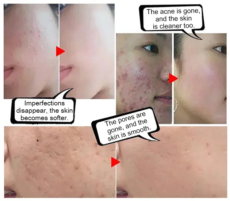 Electronic Acne Patches - 6pcs