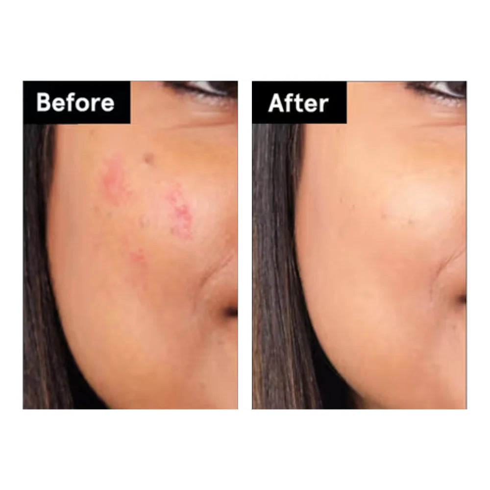 Electronic Acne Patches - 6pcs
