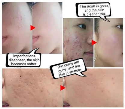 Electronic Acne Patches - 6pcs